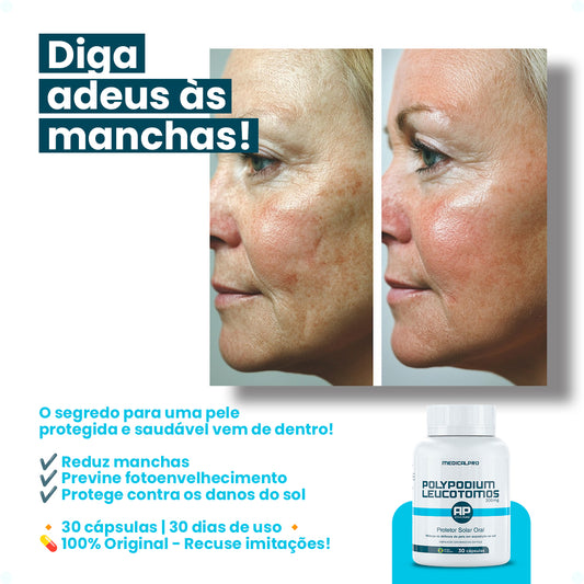 Polypodium Leucotomos 300mg Fotoprotetor Solar + Antimelasma Medical Pro 30caps