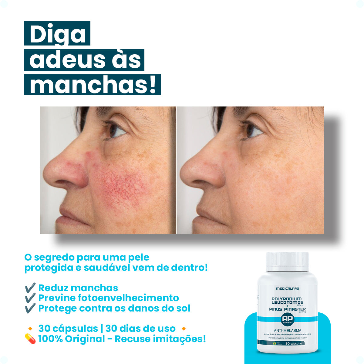 Polypodium Leucotomos 300mg + Pinus Pinaster 250mg Anti Melasma Medical Pro 30caps