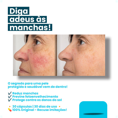 Polypodium Leucotomos 300mg + Picnogenol 250mg Anti Melasma Medical Pro 30 caps